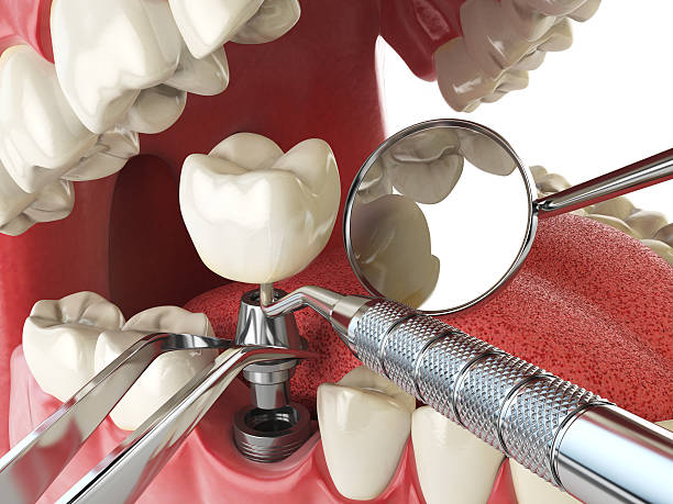 Best Emergency Denture Repair in Auburn, KY