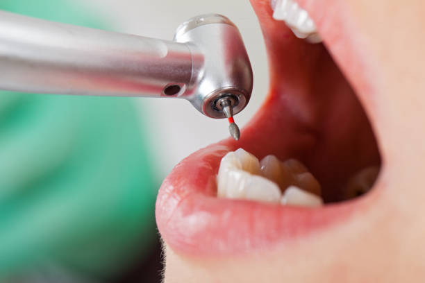 Best Broken or Chipped Tooth Repair in Auburn, KY